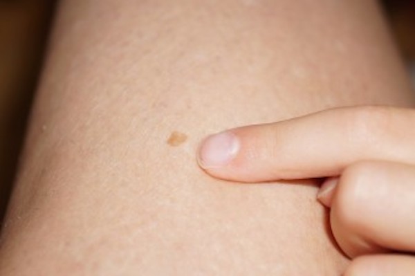 Do your brown spots look like this? Take the prevention steps and visit your dermatologist for a yearly screening.