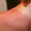 The Best Natural Remedy for Your Sunburn