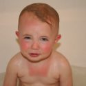 Parents: The Vital Importance of Protecting Your Redhead Kids from the Sun