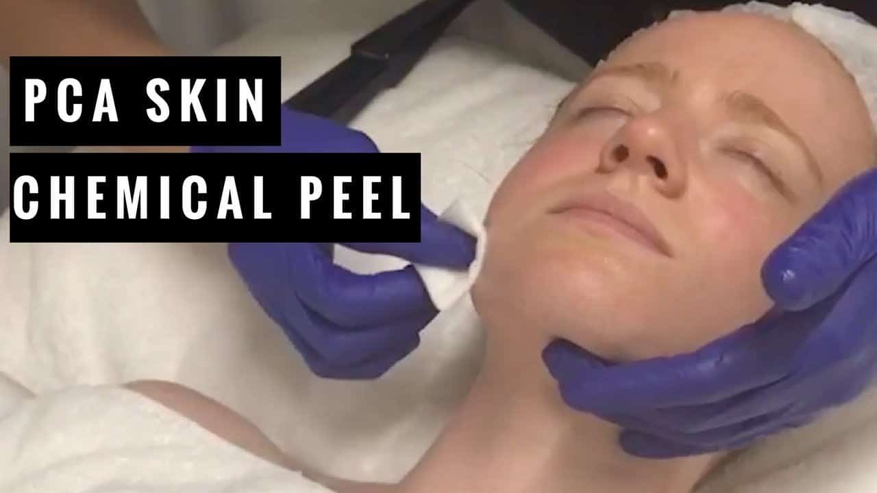 Chemical Peel Treatment 101: The Basics for Redheads