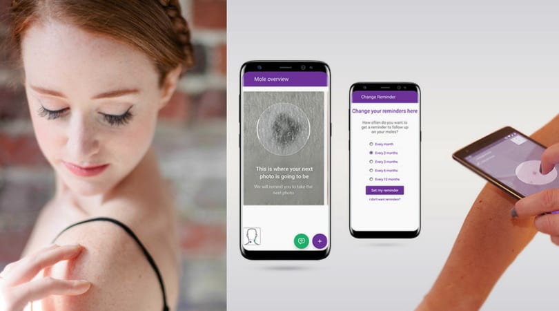 ‘Miiskin’ App Helps Keep Track Of Your Moles and Freckles