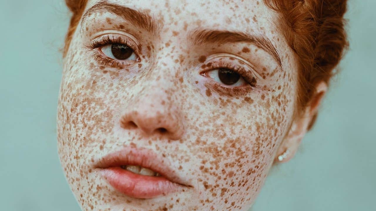 Photographer Captures the Beauty of Freckles in All Their Glory
