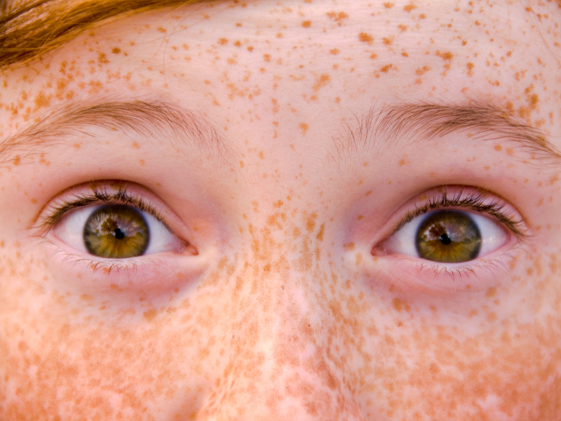 Will Your Redhead Baby Have Freckles?