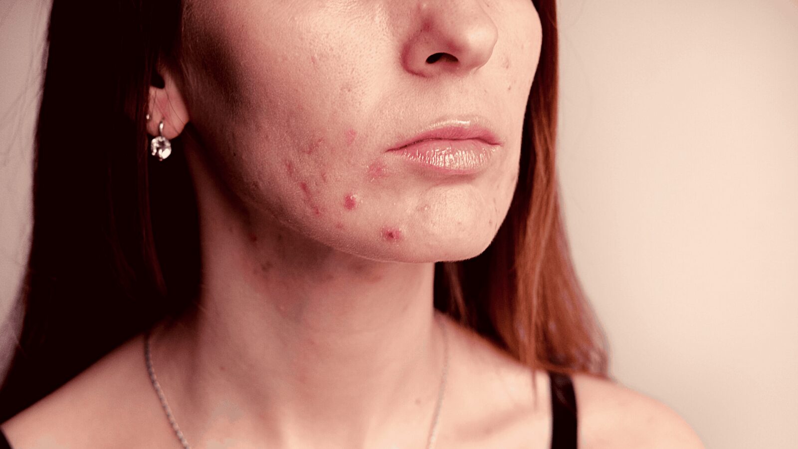 7 ‘Redhead Friendly’ Products for Cystic Acne