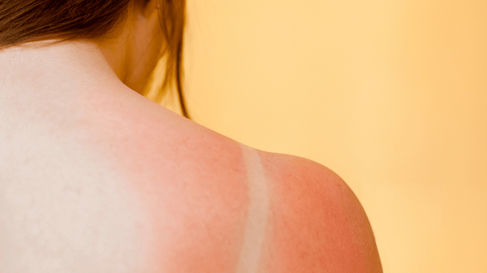 The 11 Best Sunburn Relief Gels and Lotions For Your Redhead Skin