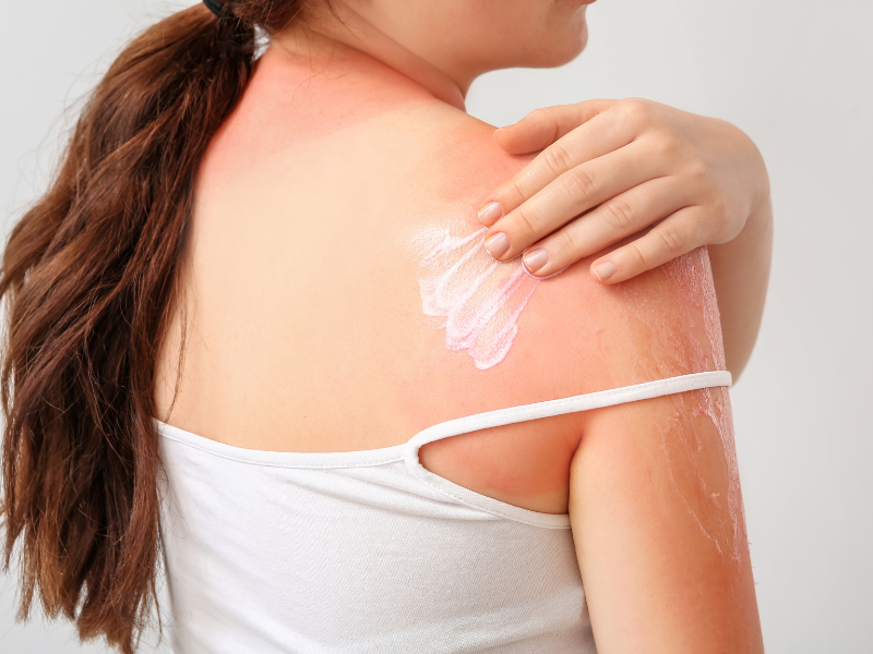 How Redheads Can Treat a Sunburn Quickly At Home