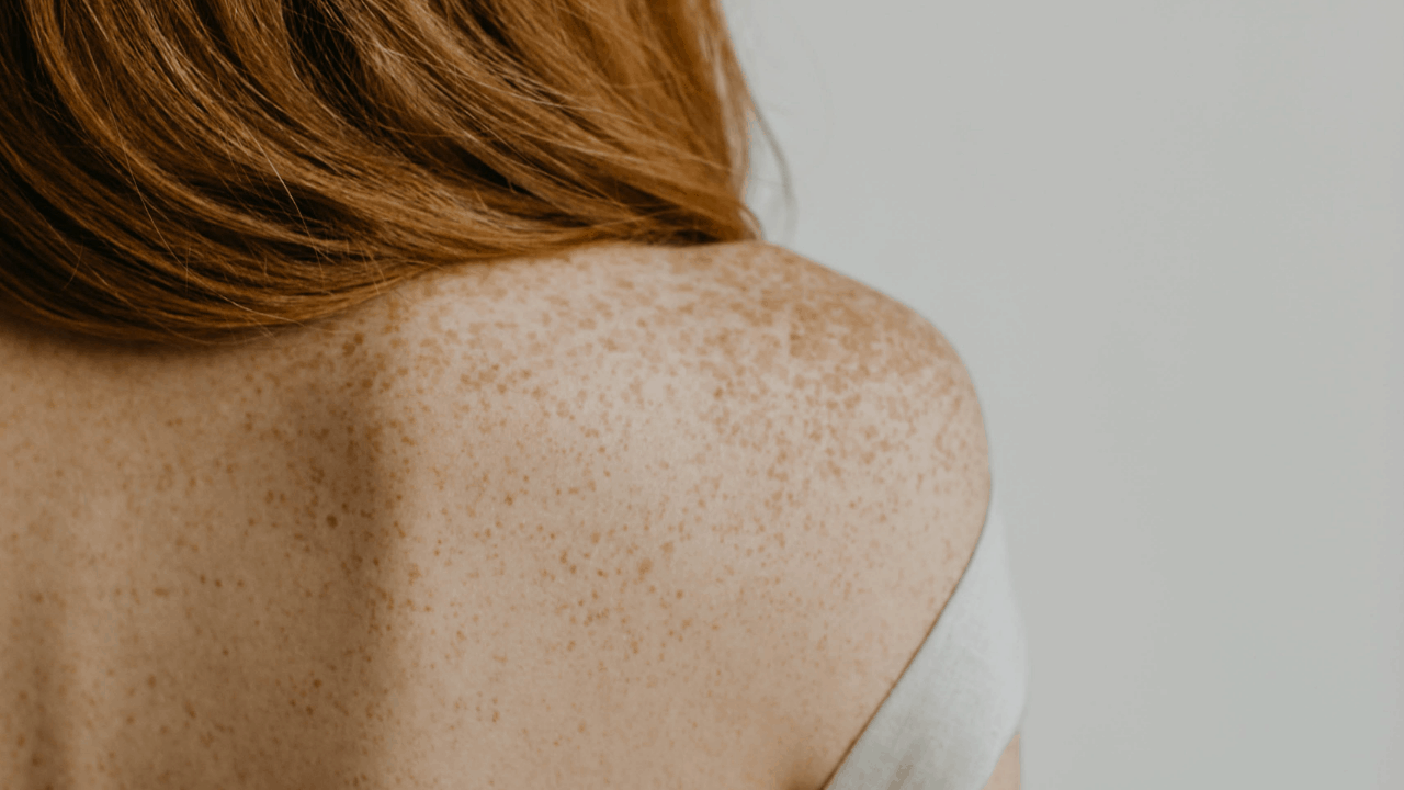 How Redheads Can Take Care of (Not Get Rid of) Their Summer Freckles