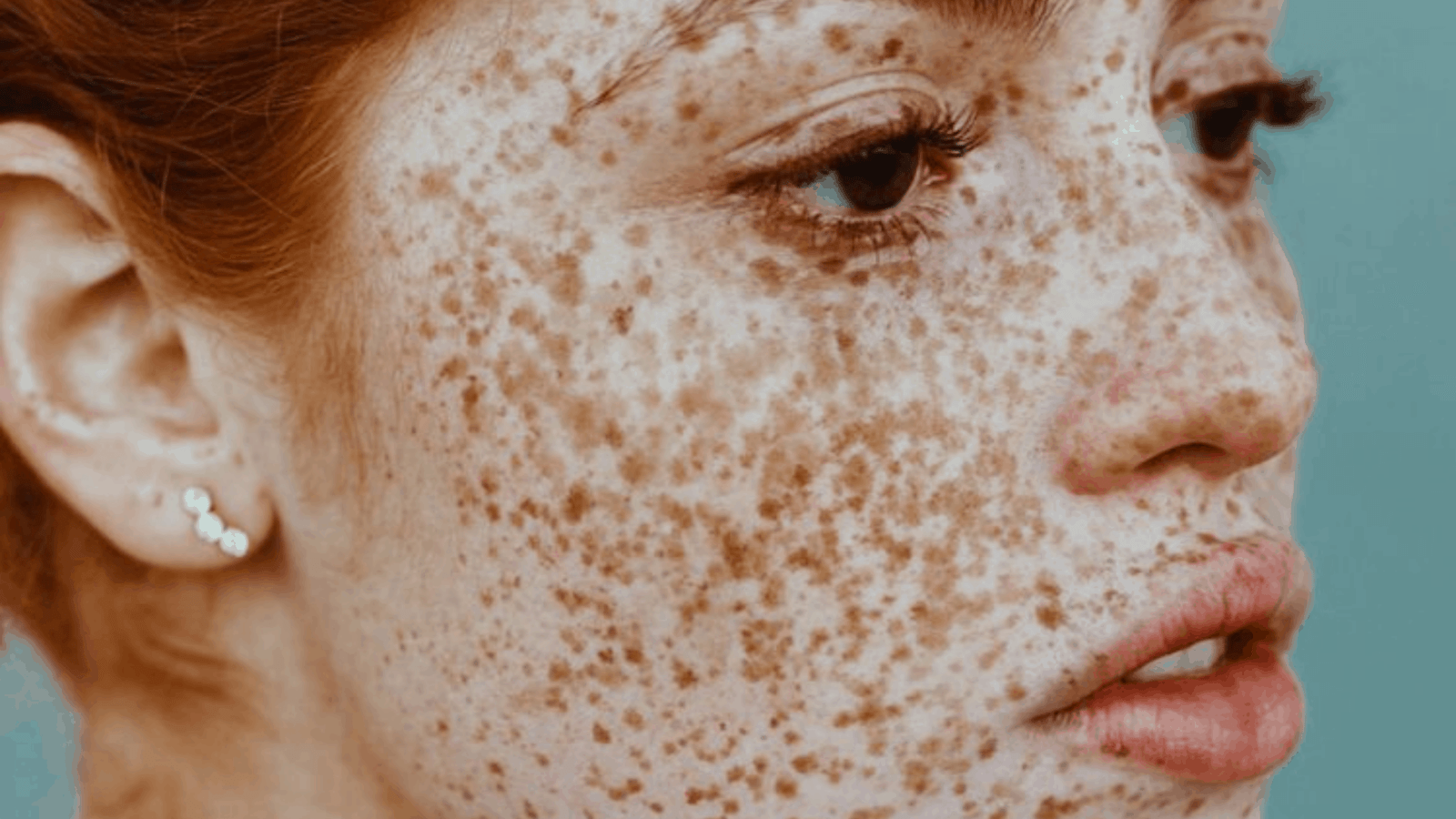 Why Do Freckles Come Out in the Sun?