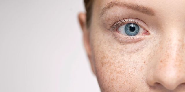 What Redheads Should Know About Under Eye Eczema