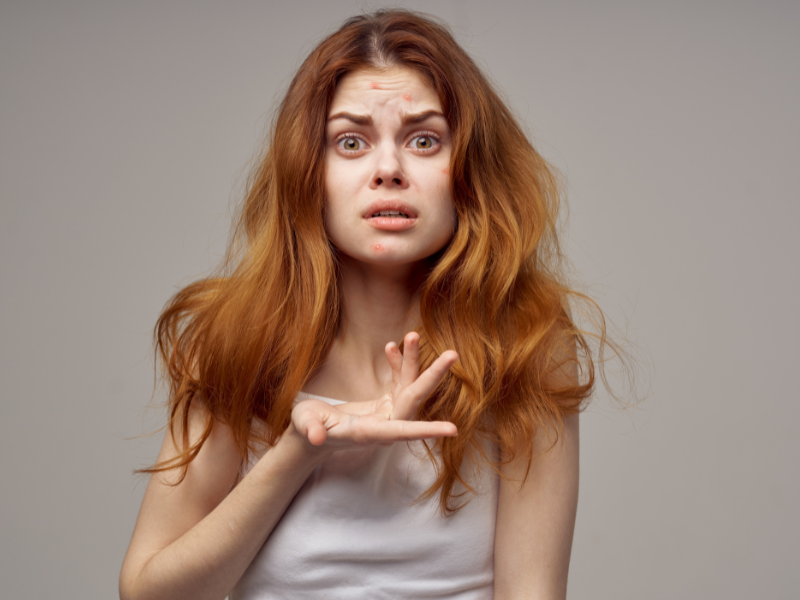 How Redheads Can Get Rid of Hairline Acne