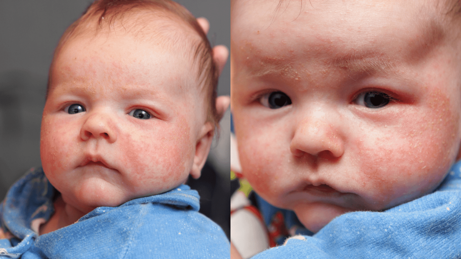 Does Bleach Bath Therapy Work on Redhead Babies/Toddlers?