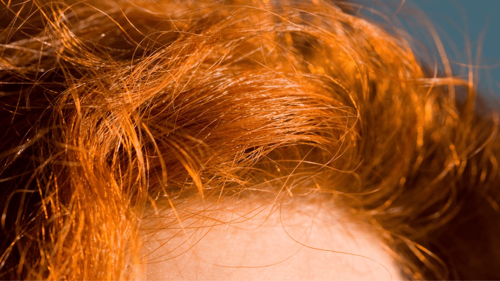 What to Know About Scalp Acne and Why Redheads Suffer From It