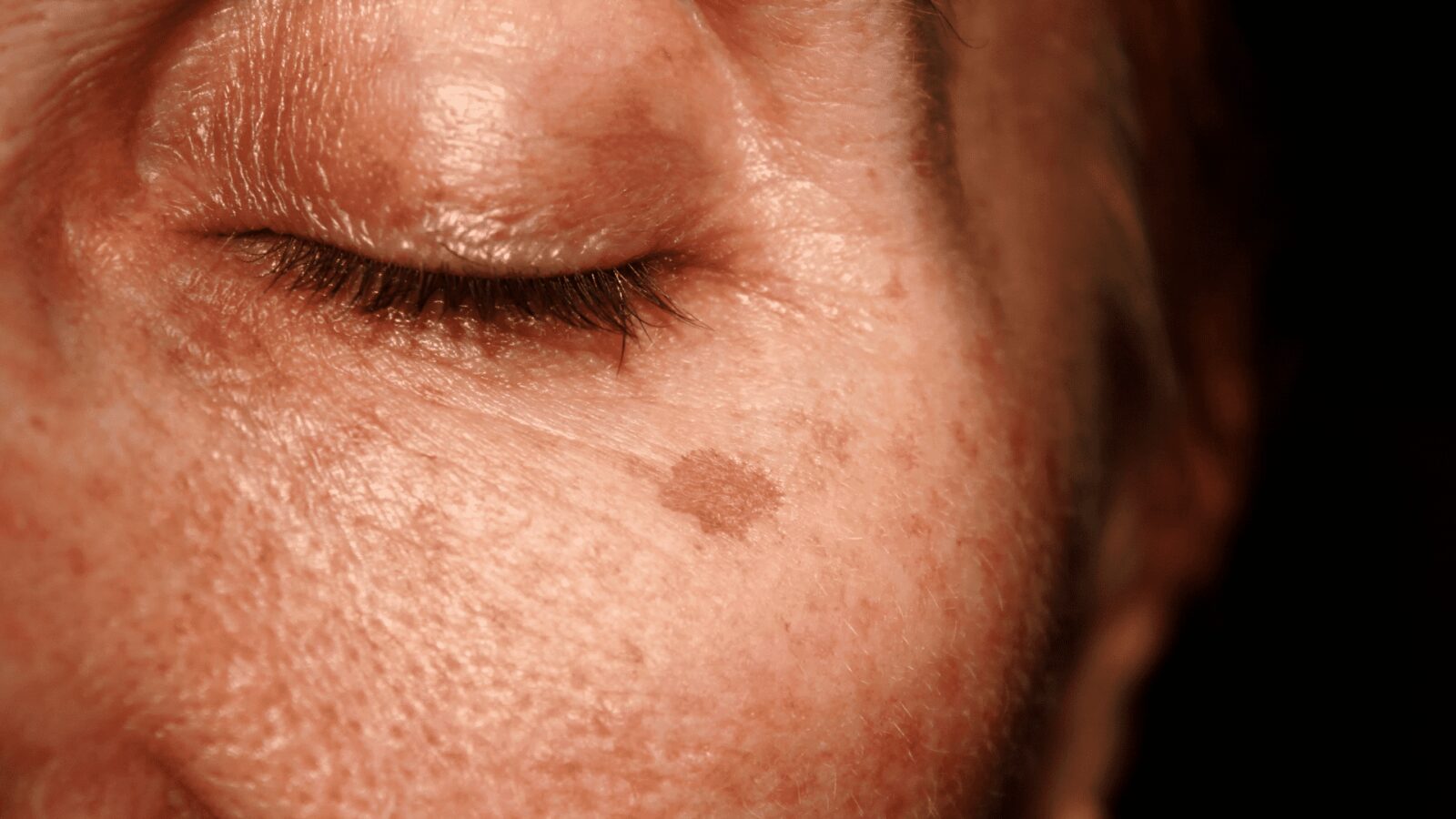 Pigmentation 101: Why it Happens and How Redheads Can Treat It