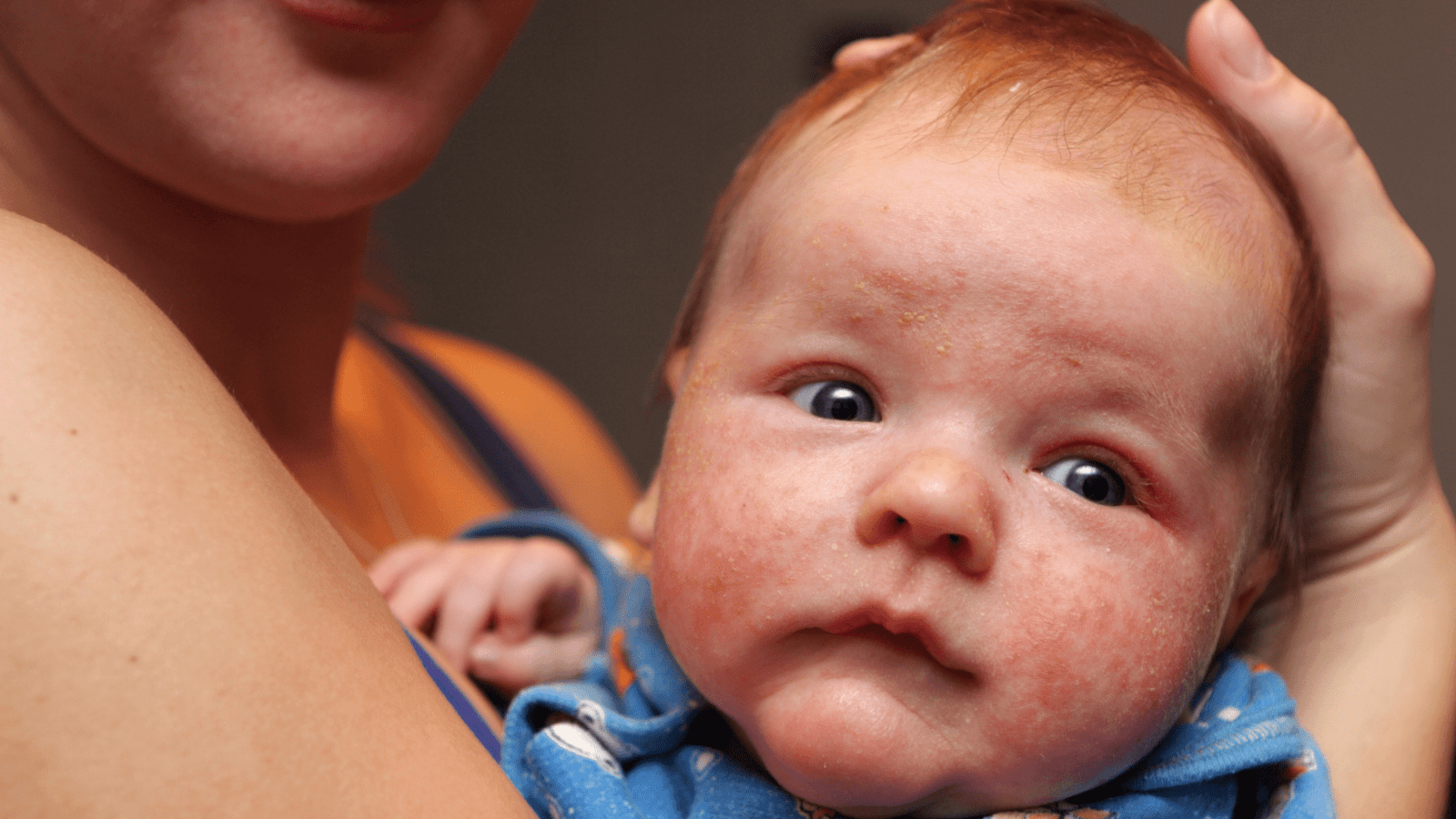 Everything Redheads Need to Know About Contact Dermatitis