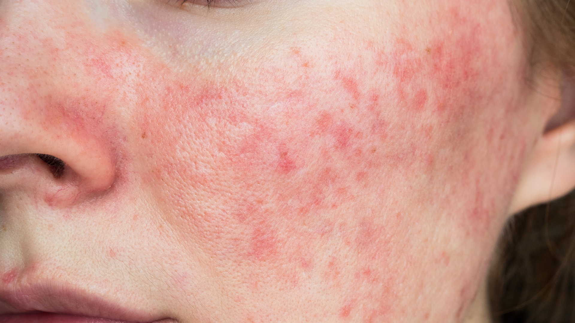6 Redhead-Friendly Tips for Treating Rosacea