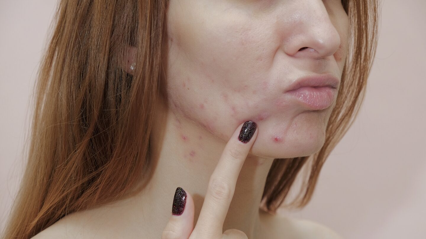 4 Ways Redheads Can Combat Blind Pimples