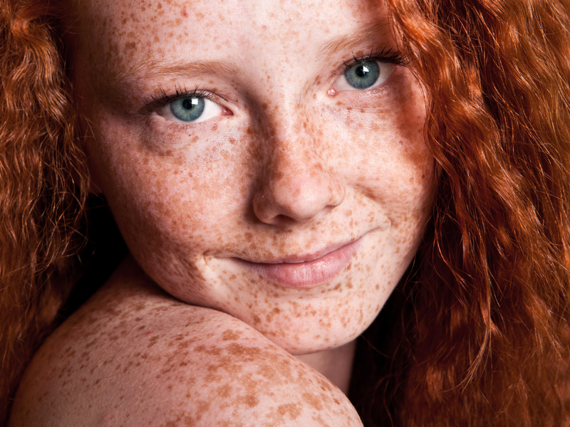 Freckles & Moles: This Is When Redheads Should Get Checked By A Dermatologist