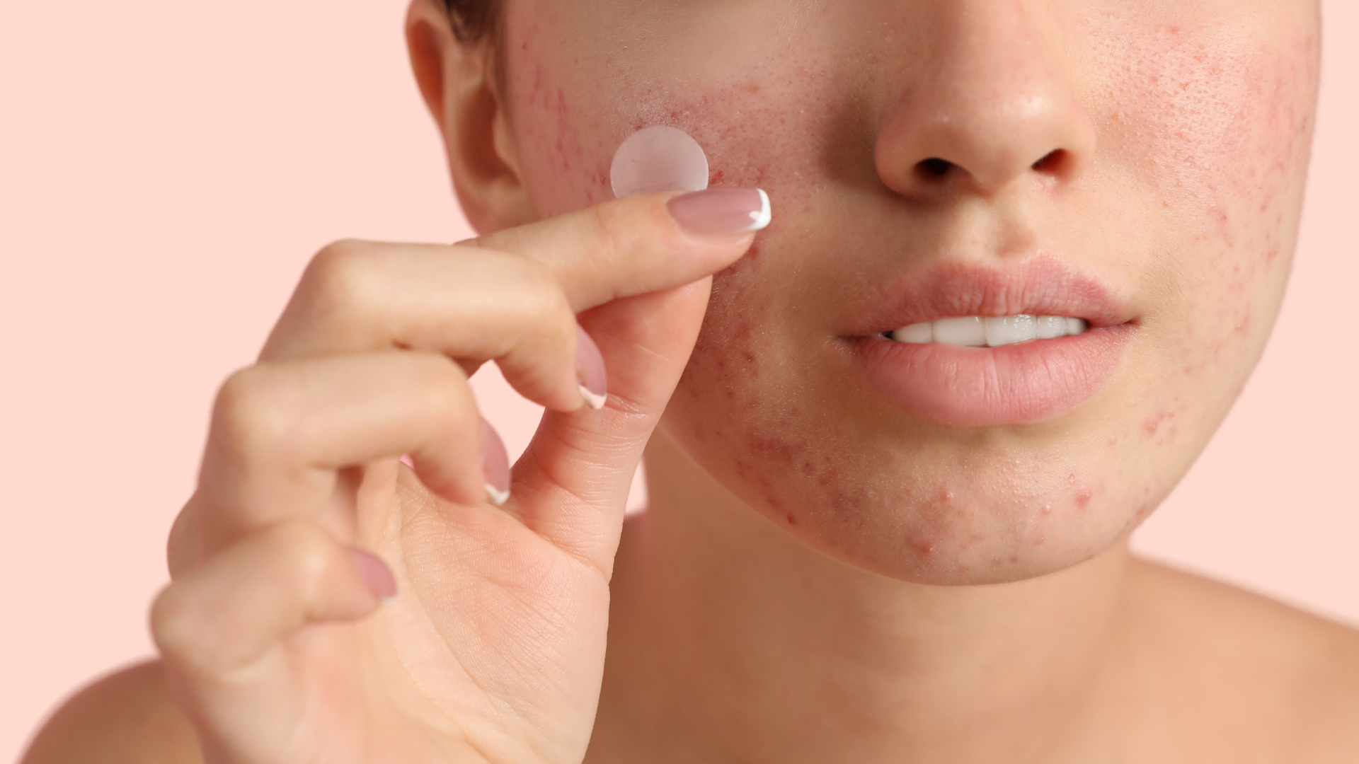 Pimple Patch 101: The Do’s and Don’ts of Pimple Patches for Redheads