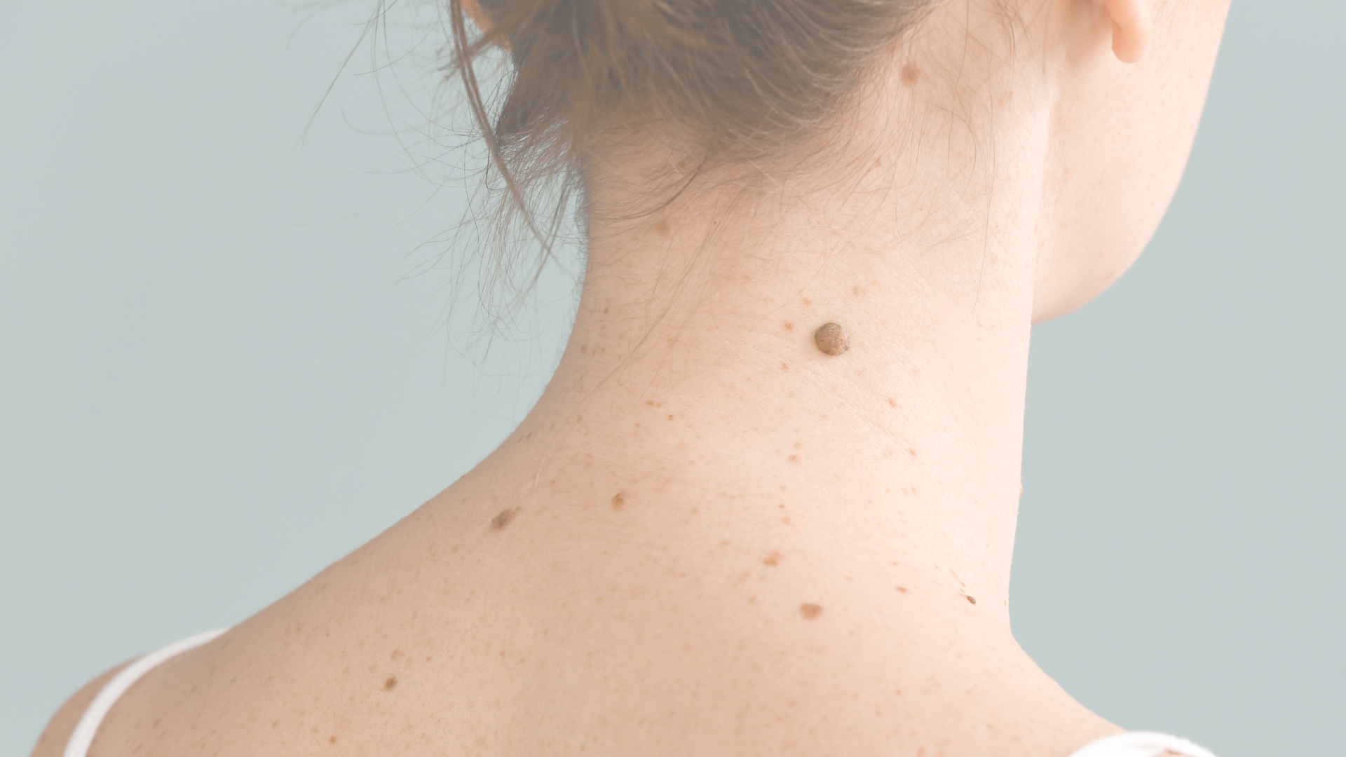 Redheads, This Could Save Your Life: Know The Signs of Melanoma