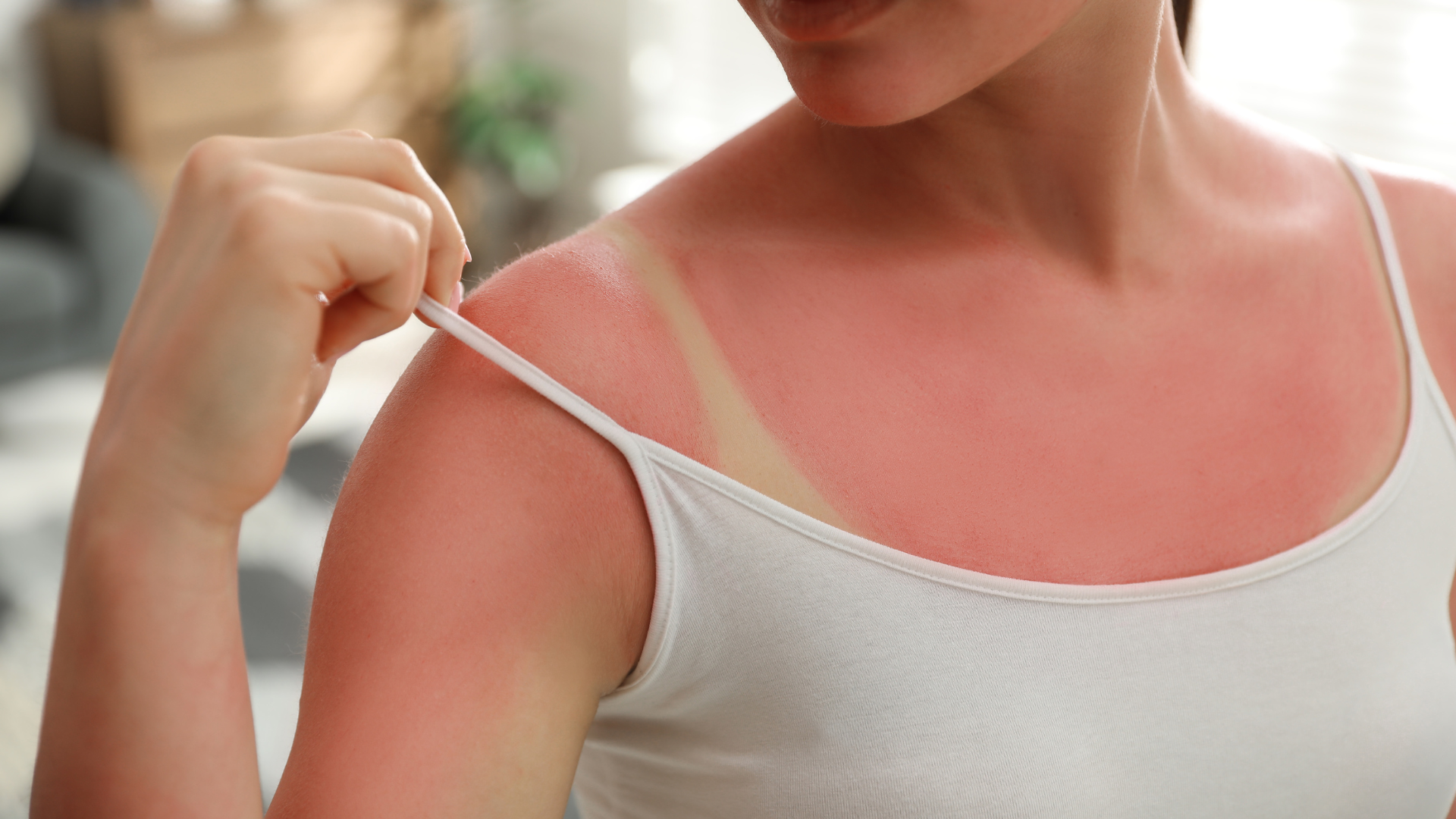 What Actually Happens When Redhead Skin Gets Sunburnt