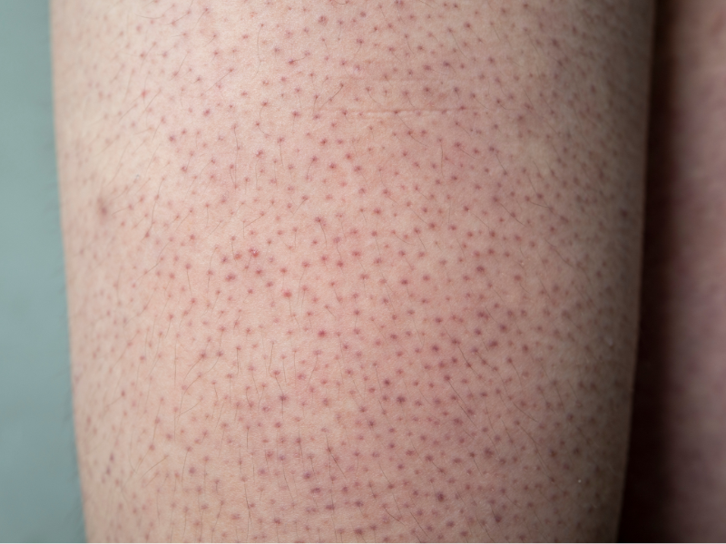 Bumpy Redhead Skin? It May Be Keratosis Pilaris + This Is How To Treat It