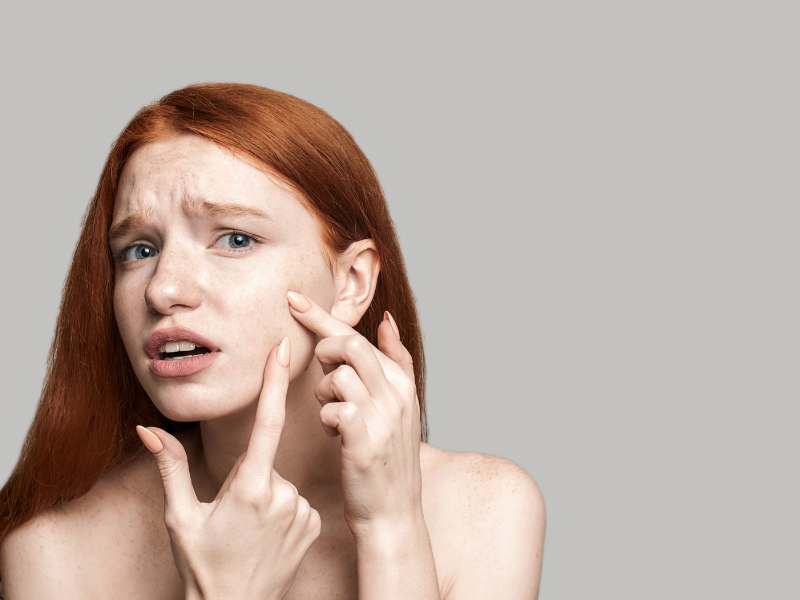 What Redheads Should Know About Biotin and Acne