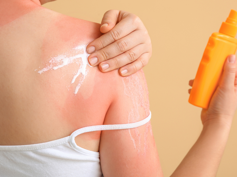 How Redheads Can Treat Peeling Skin After a Sunburn