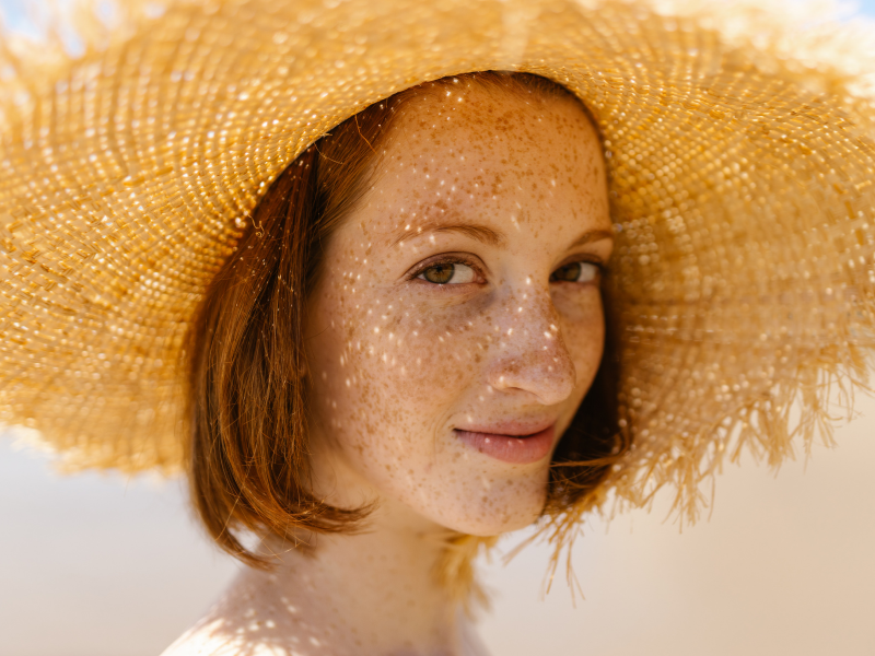 The 411: Photophobia & Light Sensitivity in Redheads
